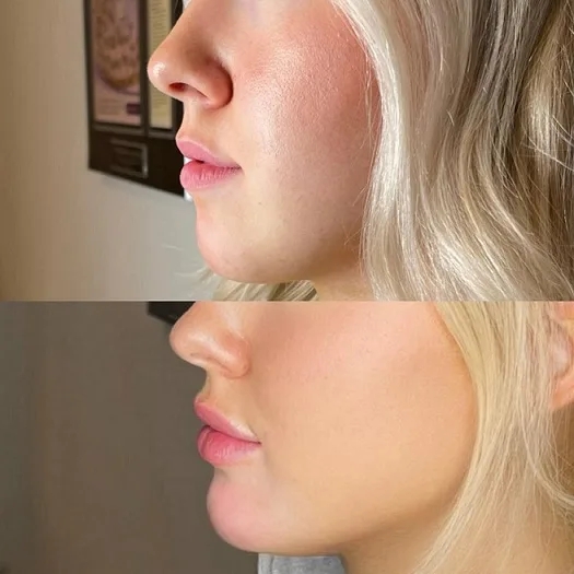 Chin Fillers for Different Face Shapes: Recommendations from the Best Aesthetic Clinic in dubai