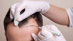 The Future of Hair Restoration: Why London is Leading the Global Hair Transplant Revolution